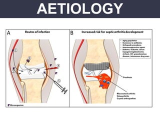 AETIOLOGY
 