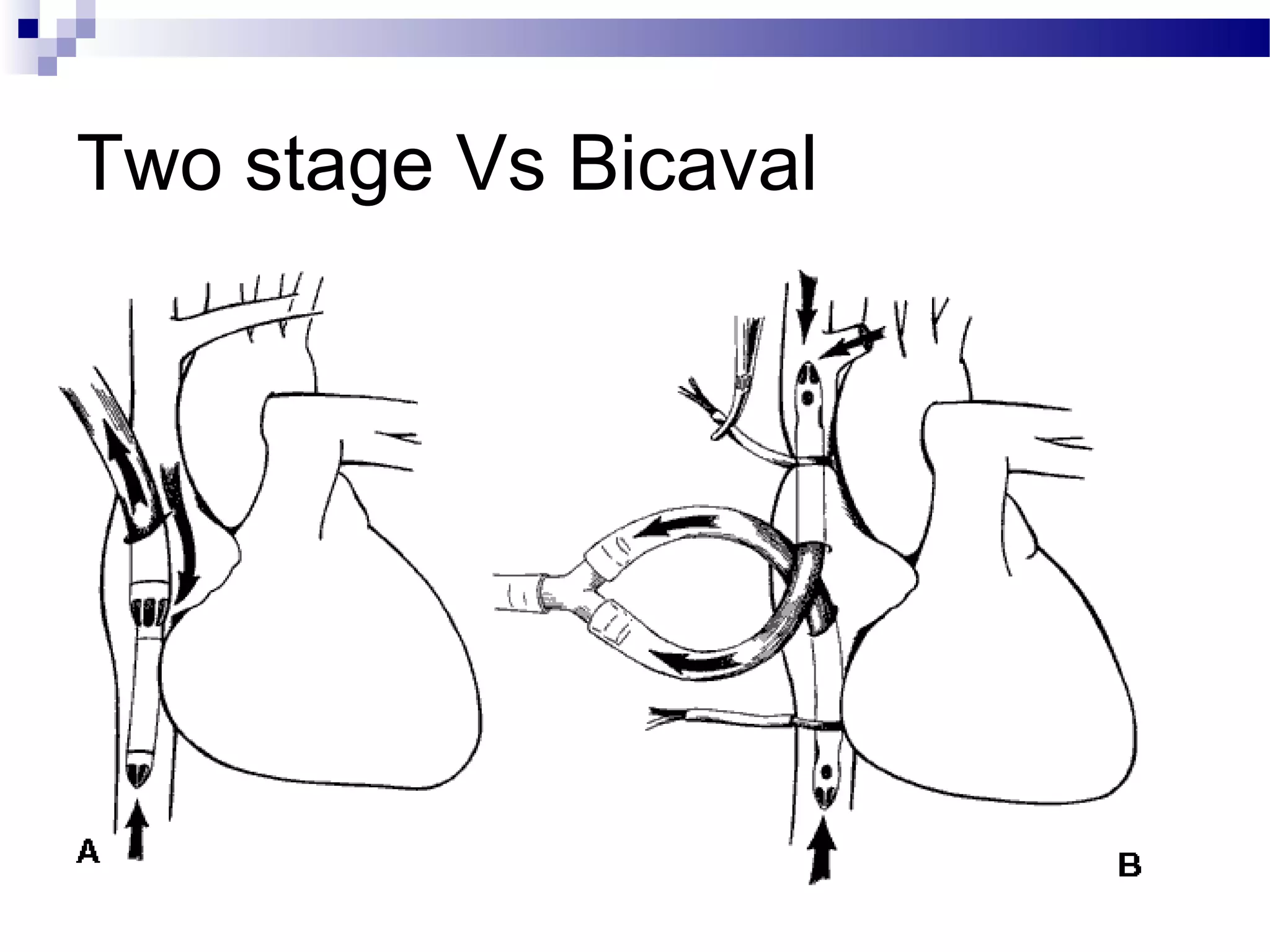 Two stage Vs Bicaval
 