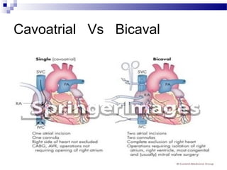 Cavoatrial Vs Bicaval
 