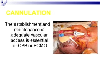 CANNULATION
The establishment and
maintenance of
adequate vascular
access is essential
for CPB or ECMO
 