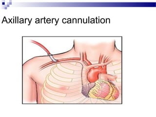 Axillary artery cannulation
 