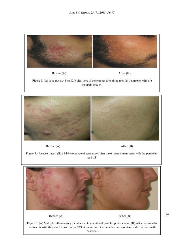 Facial Acne Therapy by Using Pumpkin Seed Oil with Its Physicochemica…