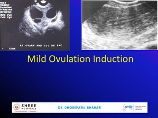 Mild Ovulation Induction
 