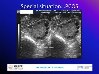 Special situation…PCOS
 