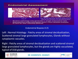 Endometrial Biopsies D 25
Left : Normal Histology : Patchy areas of stromal decidualization,
Scattered stromal large granulated lymphocytes, Glands without
cytoplasmic vacuoles.
Right : Patchy areas of stromal decidualization and scattered stromal
large granulated lymphocytes, but the glands are highly vacuolated,
typical of D18 glands.
 