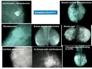 29
MAMMOGRAPHY
Calcification - fibroadenoma
fibroadenoma
Calcified galactocoele
Breast abcess sub areolar
Ca breast with
microcalcification
Fibroadenoma extending
to axilla
Breast cyst
Ca Breast with calcifications
Breast multiple fibroadenomas
 