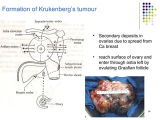 34
Formation of Krukenberg’s tumour
• Secondary deposits in
ovaries due to spread from
Ca breast
• reach surface of ovary and
enter through ostia left by
ovulating Graafian follicle
 