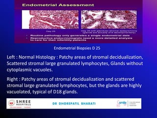 Endometrial Biopsies D 25
Left : Normal Histology : Patchy areas of stromal decidualization,
Scattered stromal large granulated lymphocytes, Glands without
cytoplasmic vacuoles.
Right : Patchy areas of stromal decidualization and scattered
stromal large granulated lymphocytes, but the glands are highly
vacuolated, typical of D18 glands.
 