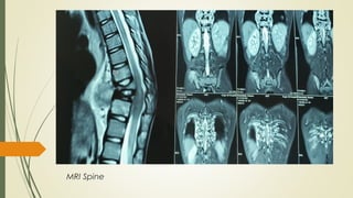 MRI Spine
 