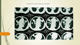 Chest CT scan done on 15/3/19
 