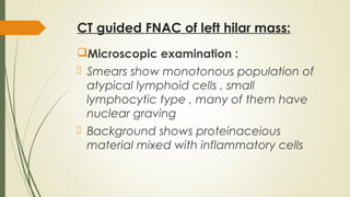 CT guided FNAC of left hilar mass:
Microscopic examination :
 Smears show monotonous population of
atypical lymphoid cells , small
lymphocytic type , many of them have
nuclear graving
 Background shows proteinaceious
material mixed with inflammatory cells
 