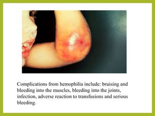 Complications from hemophilia include: bruising and
bleeding into the muscles, bleeding into the joints,
infection, adverse reaction to transfusions and serious
bleeding.
 