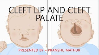 CLEFT LIP AND CLEFT
PALATE
PRESENTED BY – PRANSHU MATHUR 1
 