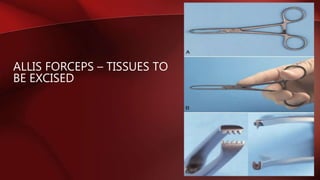 ALLIS FORCEPS – TISSUES TO
BE EXCISED
 