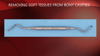 REMOVING SOFT TISSUES FROM BONY CAVITIES
 