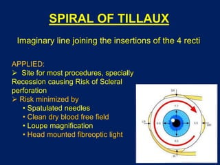 SPIRAL OF TILLAUX
Imaginary line joining the insertions of the 4 recti
APPLIED:
 Site for most procedures, specially
Recession causing Risk of Scleral
perforation
 Risk minimized by
• Spatulated needles
• Clean dry blood free field
• Loupe magnification
• Head mounted fibreoptic light
 