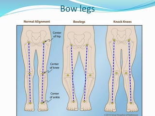 Bow legs
 