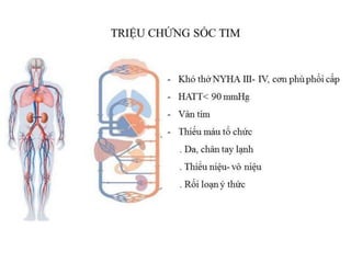 XỬ TRÍ PHÙ PHỔI CẤP VÀ SỐC TIM | PDF