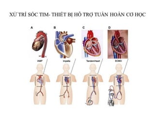 XỬ TRÍ PHÙ PHỔI CẤP VÀ SỐC TIM | PDF