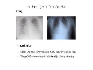 XỬ TRÍ PHÙ PHỔI CẤP VÀ SỐC TIM | PDF