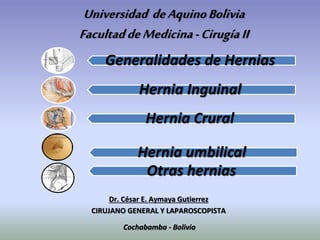 Universidad deAquinoBolivia
FacultaddeMedicina-CirugíaII
Dr. César E. Aymaya Gutierrez
CIRUJANO GENERAL Y LAPAROSCOPISTA
Cochabamba - Bolivia
Generalidades de Hernias
Hernia Inguinal
Hernia Crural
Hernia umbilical
Otras hernias
 