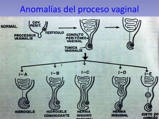 Anomalías del proceso vaginal
 