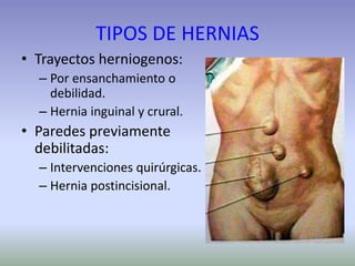 TIPOS DE HERNIAS
• Trayectos herniogenos:
– Por ensanchamiento o
debilidad.
– Hernia inguinal y crural.
• Paredes previamente
debilitadas:
– Intervenciones quirúrgicas.
– Hernia postincisional.
 