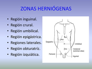 ZONAS HERNIÓGENAS
• Región inguinal.
• Región crural.
• Región umbilical.
• Región epigástrica.
• Regiones laterales.
• Región obturatríz.
• Región izquiática.
 