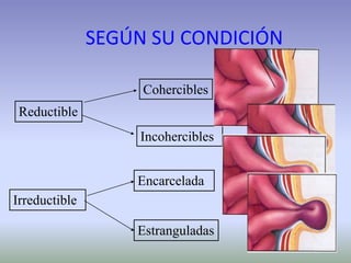 SEGÚN SU CONDICIÓN
Reductible
Irreductible
Cohercibles
Incohercibles
Encarcelada
Estranguladas
 