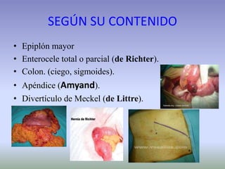 SEGÚN SU CONTENIDO
• Epiplón mayor
• Enterocele total o parcial (de Richter).
• Colon. (ciego, sigmoides).
• Apéndice (Amyand).
• Divertículo de Meckel (de Littre).
 
