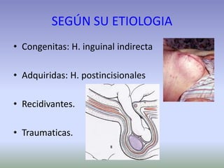 SEGÚN SU ETIOLOGIA
• Congenitas: H. inguinal indirecta
• Adquiridas: H. postincisionales
• Recidivantes.
• Traumaticas.
 