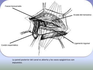 La pared posterior del canal es abierta y los vasos epigástricos son
expuestos.
 