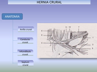 HERNIA CRURAL
ANATOMIA
Anillo crural
Conducto
crural
Infundíbulo
crural
Septum
crural
 
