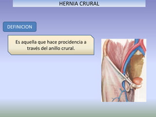 HERNIA CRURAL
DEFINICION
Es aquella que hace procidencia a
través del anillo crural.
 