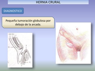 HERNIA CRURAL
DIAGNOSTICO
Pequeña tumoración globulosa por
debajo de la arcada.
 