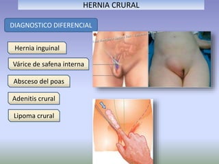 HERNIA CRURAL
DIAGNOSTICO DIFERENCIAL
Hernia inguinal
Várice de safena interna
Absceso del poas
Adenitis crural
Lipoma crural
 