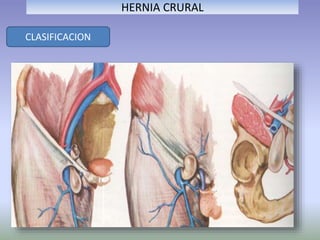 HERNIA CRURAL
CLASIFICACION
 