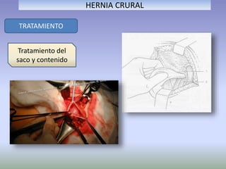 TRATAMIENTO
HERNIA CRURAL
Tratamiento del
saco y contenido
 