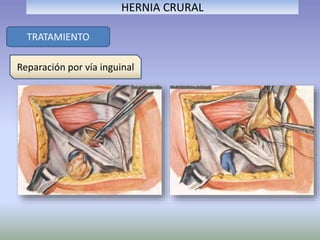 TRATAMIENTO
HERNIA CRURAL
Reparación por vía inguinal
 