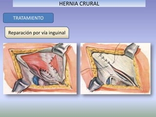 TRATAMIENTO
HERNIA CRURAL
Reparación por vía inguinal
 