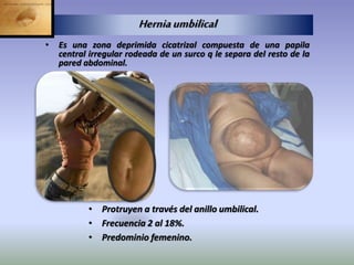 Herniaumbilical
• Es una zona deprimida cicatrizal compuesta de una papila
central irregular rodeada de un surco q le separa del resto de la
pared abdominal.
• Protruyen a través del anillo umbilical.
• Frecuencia 2 al 18%.
• Predominio femenino.
 