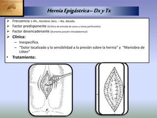  Frecuencia 1-4%., Hombres 3era. – 4ta. década.
 Factor predisponente (Orificio de entrada de vasos y ramas perforantes)
 Factor desencadenante (Aumento presión intraabdominal)
 Clínica:
– Inespecifíca.
– “Dolor localizado y la sensibilidad a la presión sobre la hernia” y “Maniobra de
Litten”
• Tratamiento:.
HerniaEpigástrica–DxyTx
 