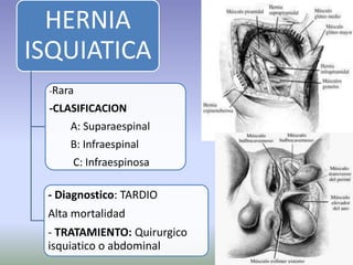 HERNIA
ISQUIATICA
-Rara
-CLASIFICACION
A: Suparaespinal
B: Infraespinal
C: Infraespinosa
- Diagnostico: TARDIO
Alta mortalidad
- TRATAMIENTO: Quirurgico
isquiatico o abdominal
 
