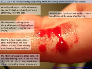 6.3.U2 Cuts in the skin are sealed by blood clotting. AND 6.3.U3 Clotting factors are released from platelets.
https://commons.wikimedia.org/wiki/File:Bleeding_finger.jpg
Wounds such as cuts to the skin causes
opening through which pathogens can
potentially enter the body Blood clots at the site of a wound to prevent
blood loss and the entry of pathogens.
Platelets (small cell fragments)
along with damaged tissue release
clotting factors in response to a
wound.
Clotting factors cause a series
of reactions which end with
fibrin (a protein) fibres forming
a mesh across the wound site.
The fibrin fibres capture blood cells and
platelets forming a clot. In the presence
of air the clot dries to form a scab with
shields the healing tissues underneath
 