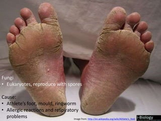 Fungi
• Eukaryotes, reproduce with spores
Cause:
• Athlete’s foot, mould, ringworm
• Allergic reactions and respiratory
problems Image from: http://en.wikipedia.org/wiki/Athlete's_foot
 