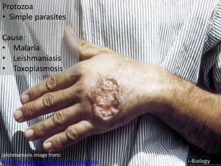 Protozoa
• Simple parasites
Cause:
• Malaria
• Leishmaniasis
• Toxoplasmosis
Leishmaniasis image from:
http://en.wikipedia.org/wiki/Leishmaniasis
 