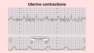 Uterine contractions
 
