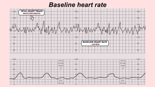 Baseline heart rate
 
