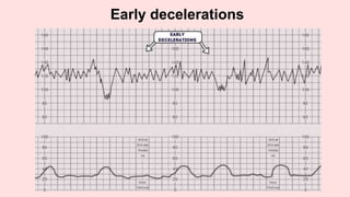 Early decelerations
 