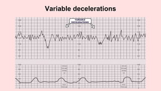 Variable decelerations
 